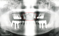 術後　前歯は局部義歯